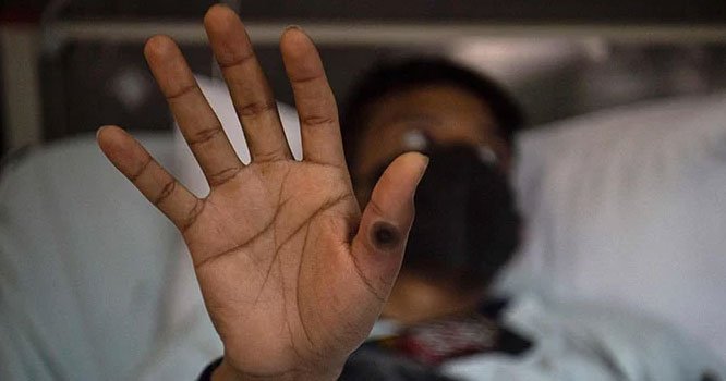 Monkeypox still global health emergency: WHO