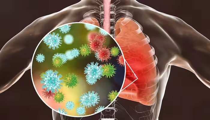 Pneumonia Outbreak: Five More Lives Lost, 717 New Cases in Punjab