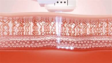 Sound Waves Are Now Killing Breast Cancer — No Knife Needed 2026
