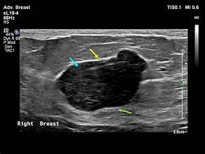 Sound Waves Are Now Killing Breast Cancer — No Knife Needed 2026